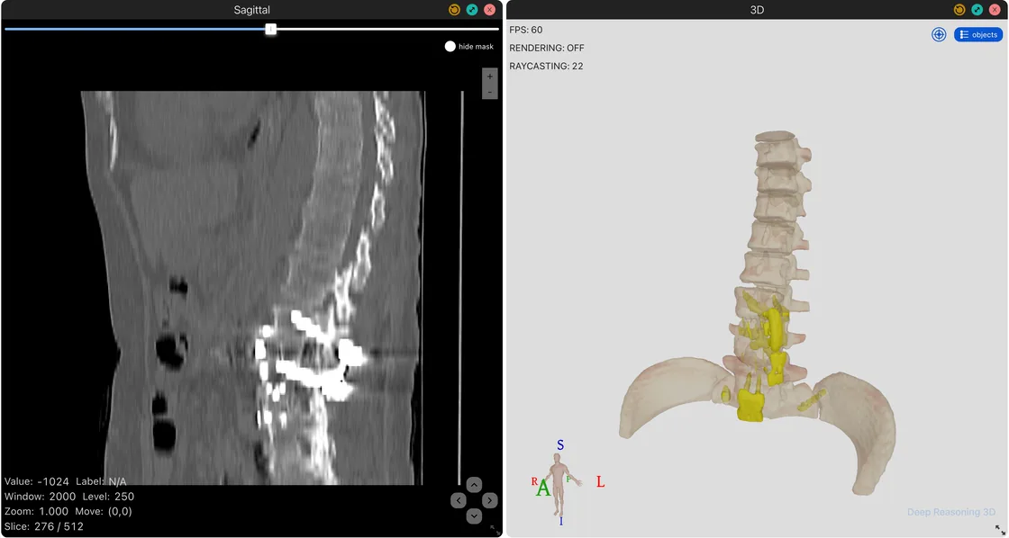 Sagittal CT beside a 3D spine and pelvis model of a complex case