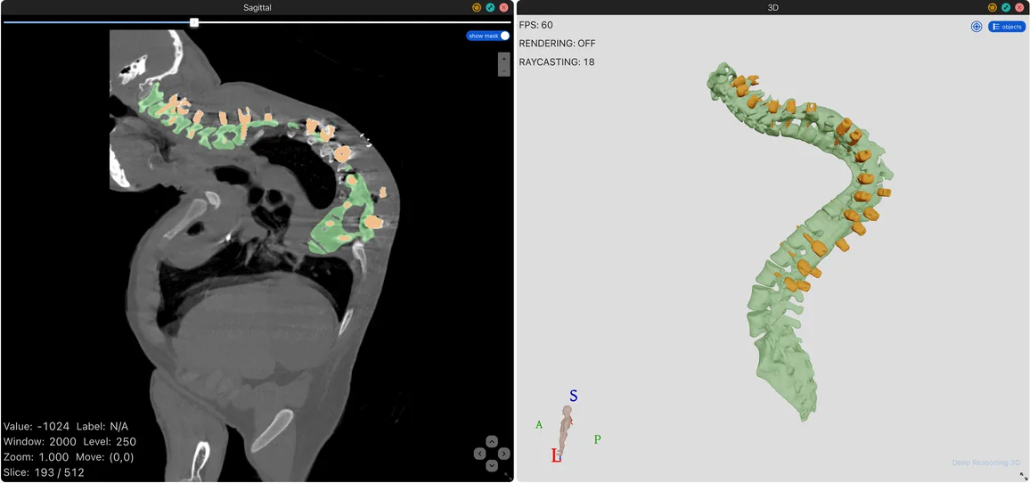 CT and 3D model of a spine with severe scoliosis