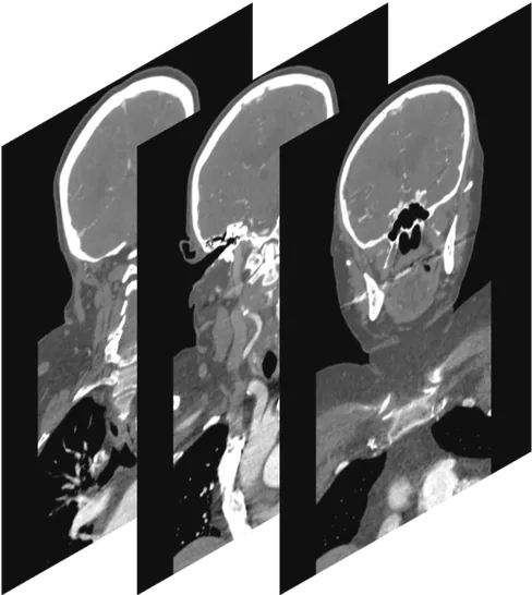 Head and neck CT angiography slices