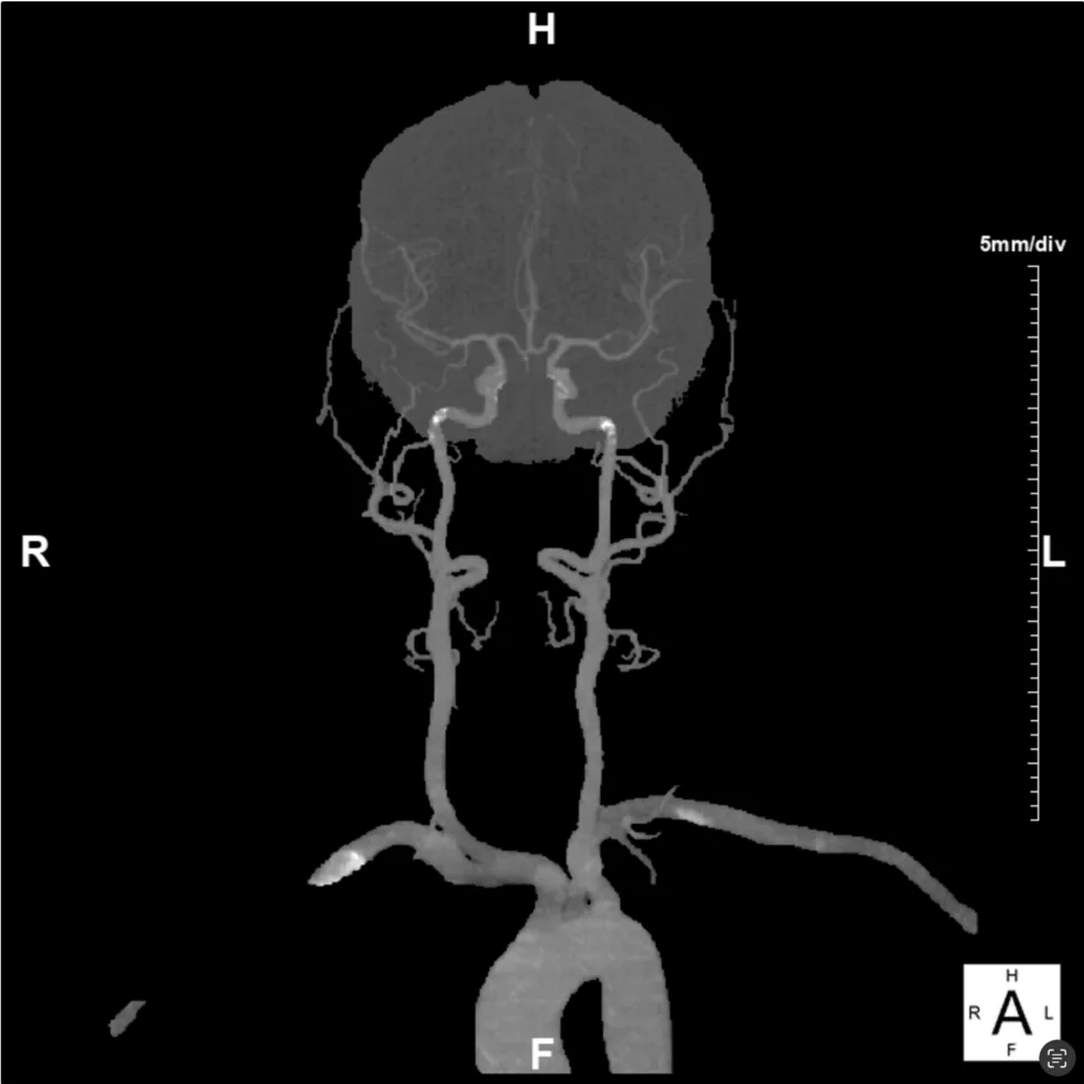 Maximum intensity projection of head and neck arteries