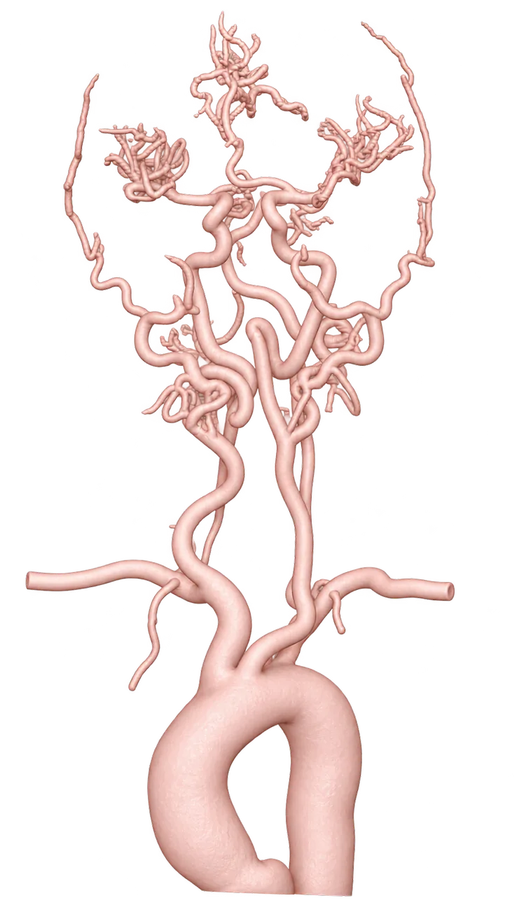 Patient-specific 3D model of head and neck arteries