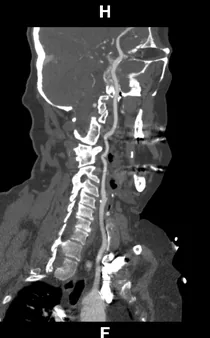 Curved planar reformation (CPR) along the carotid artery