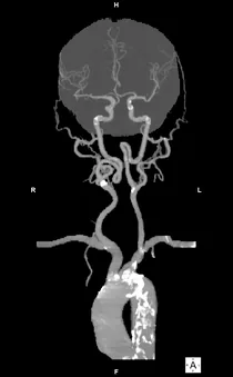 Maximum intensity projection (MIP) of the head and neck vessels