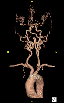 Volume rendering (VR) of the head and neck vessels
