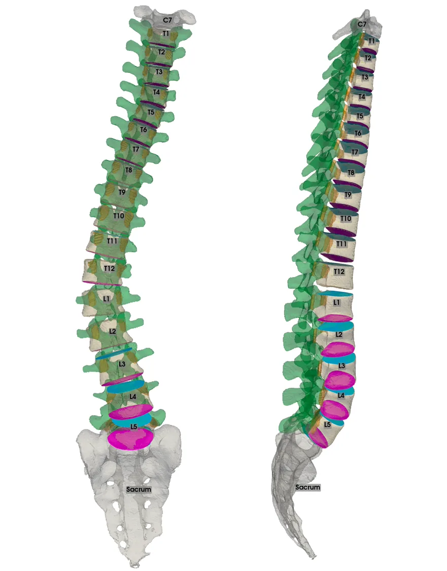 Labeled spine model with the pedicle region and intervertebral disc space marked