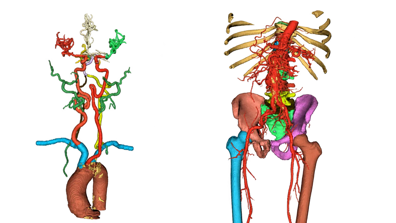3D model of the aorta and runoff arteries