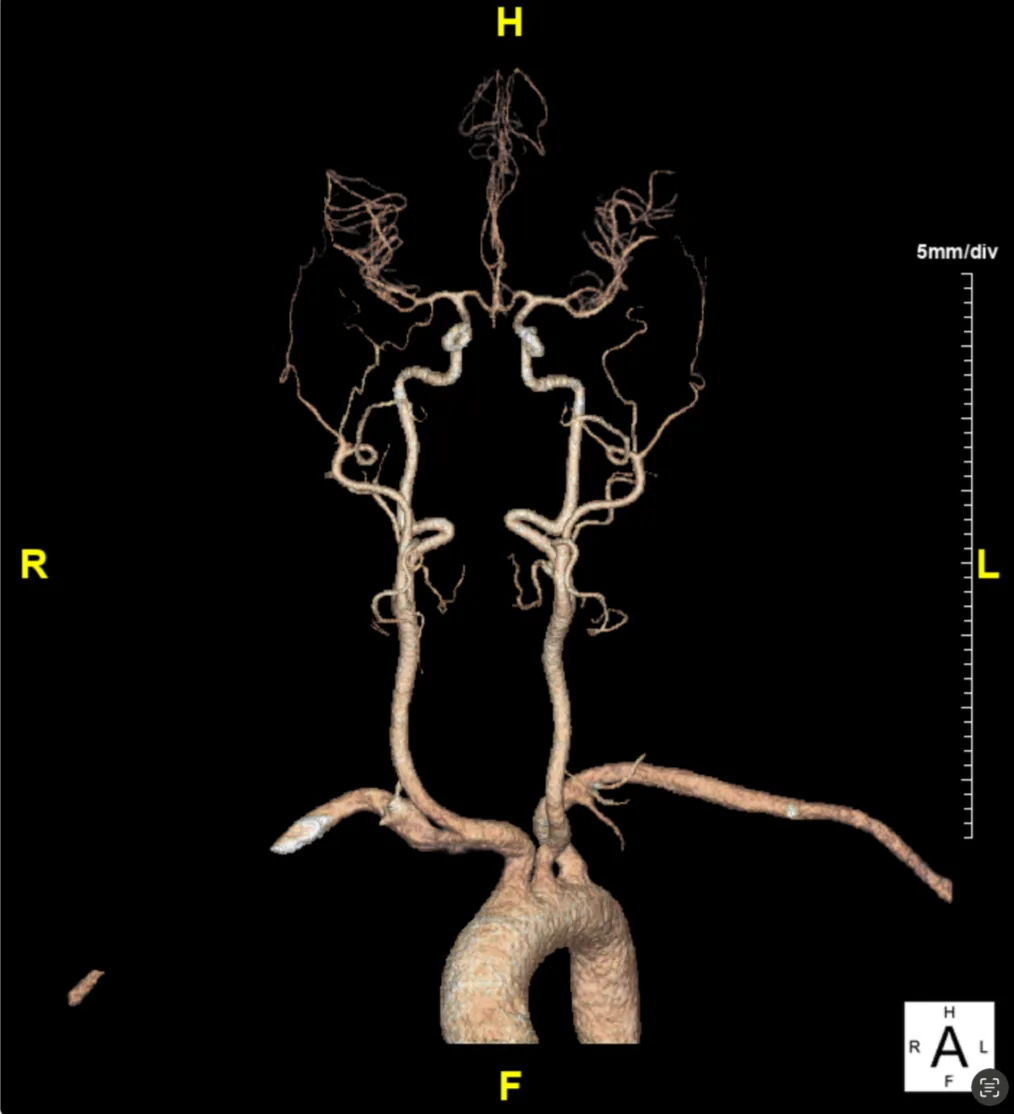 3D volume rendering of segmented head and neck arteries