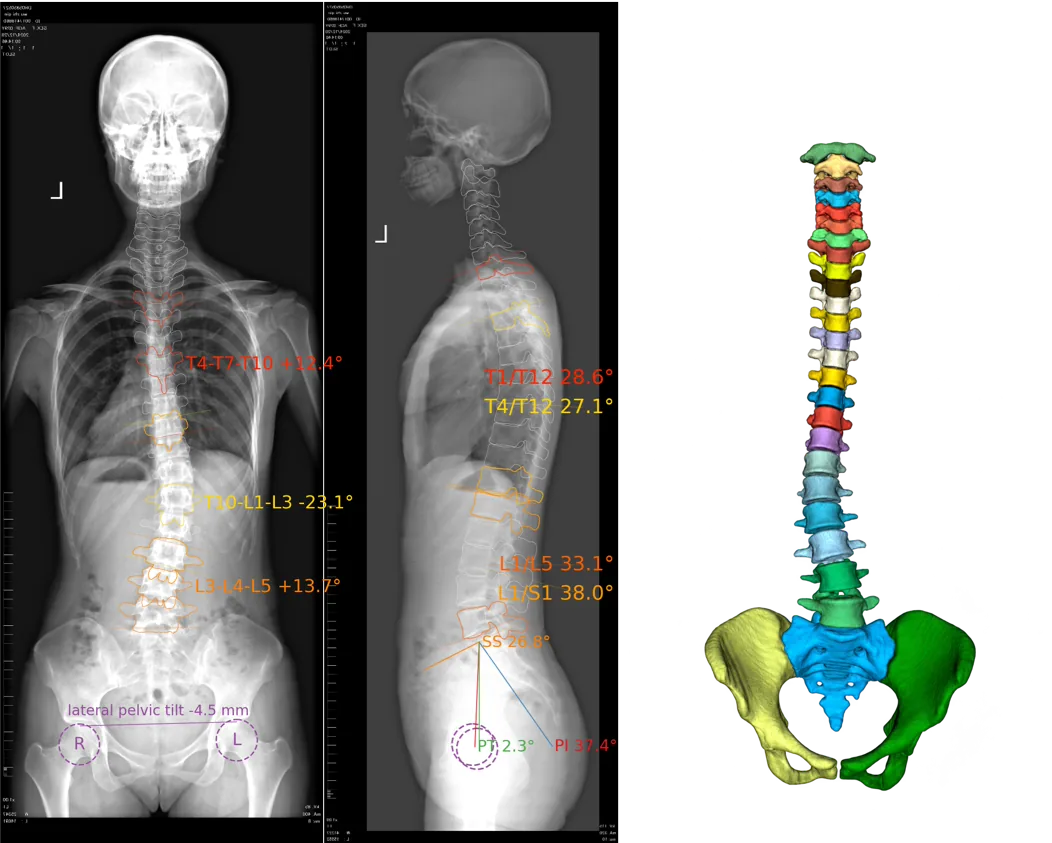 Frontal and lateral spine X-rays beside a 3D spine and pelvis model